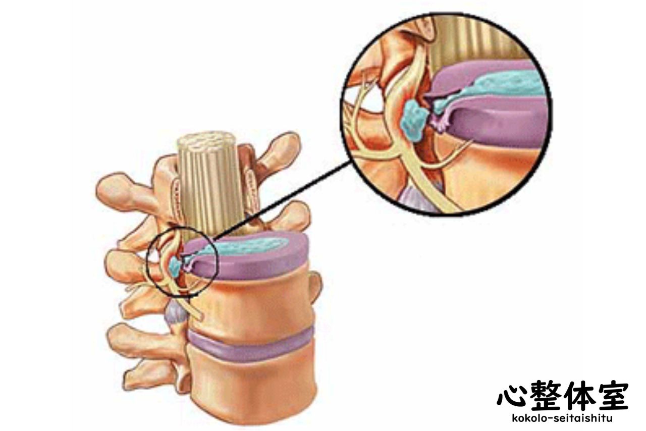 椎間板ヘルニア