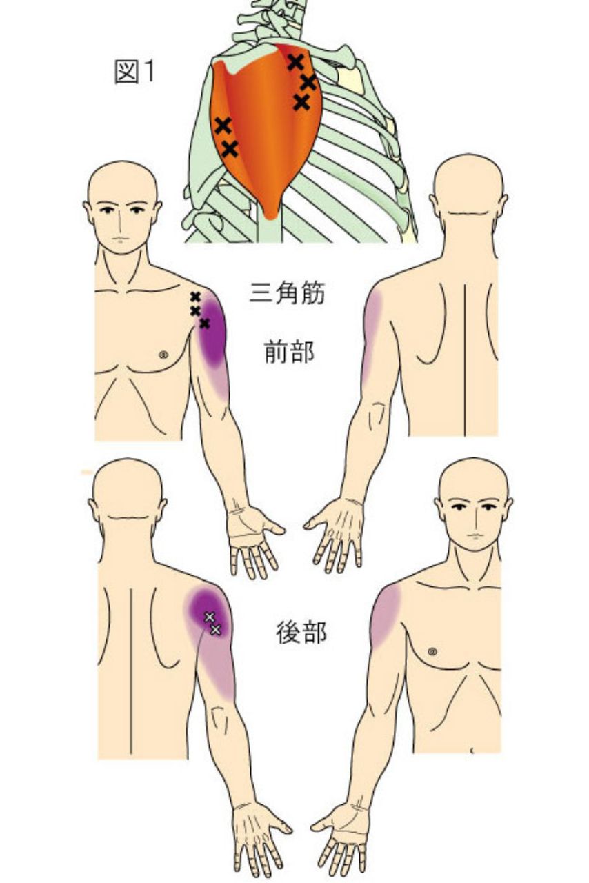 三角筋のトリガーポイント