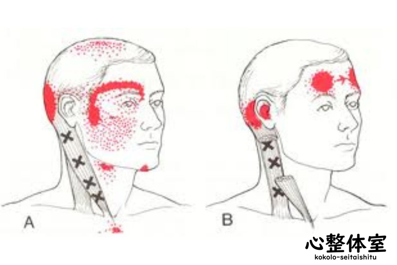 胸鎖乳突筋トリガーポイントからの関連痛