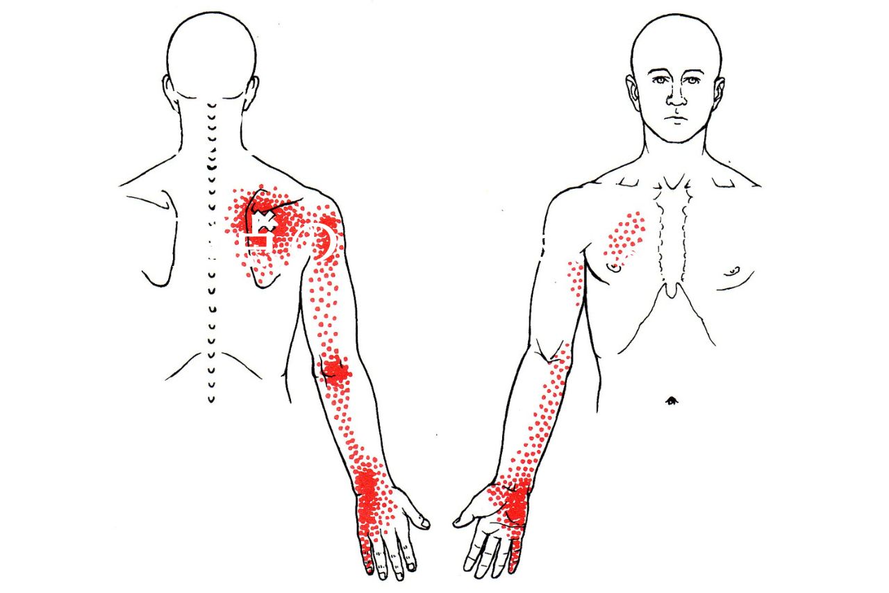 棘下筋TPの関連痛