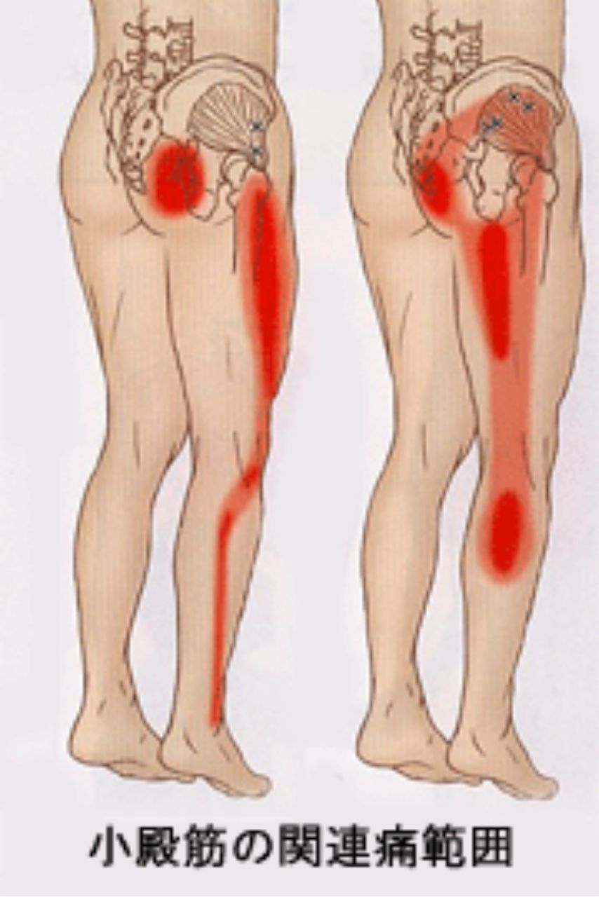 小殿筋トリガーポイントからの関連痛